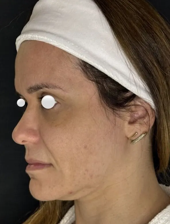 Antes — resultado facial