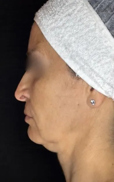 Antes — resultado facial