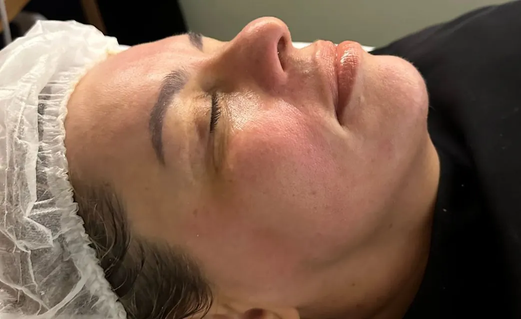 Depois — resultado facial