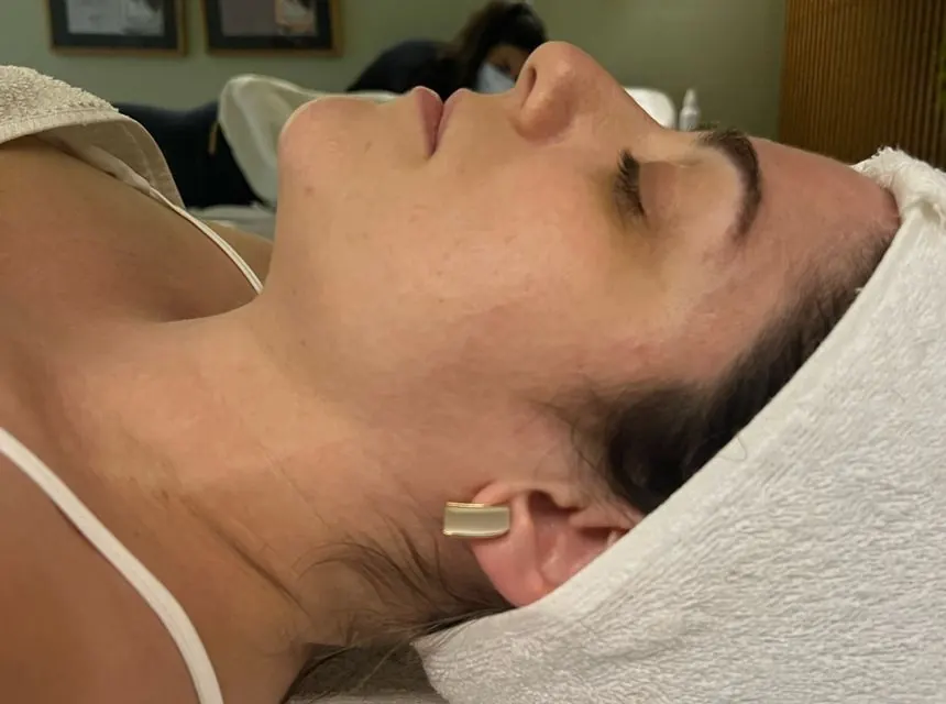 Antes — resultado facial