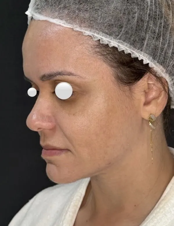 Depois — resultado facial