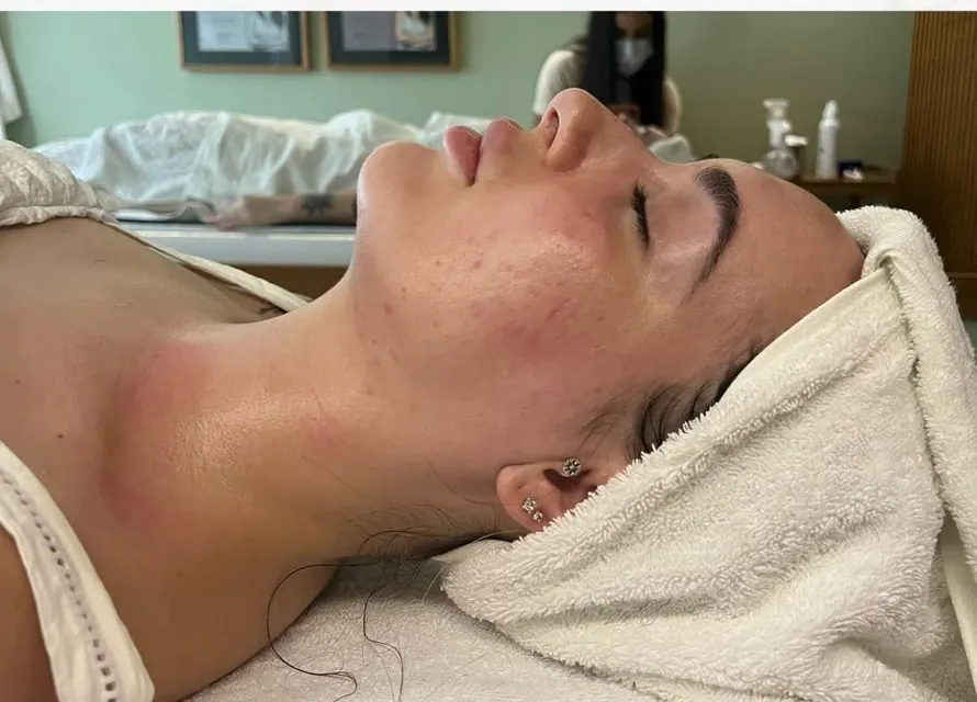 Depois — resultado facial