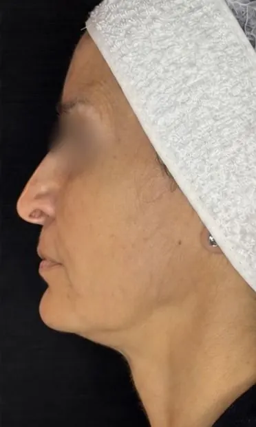 Depois — resultado facial