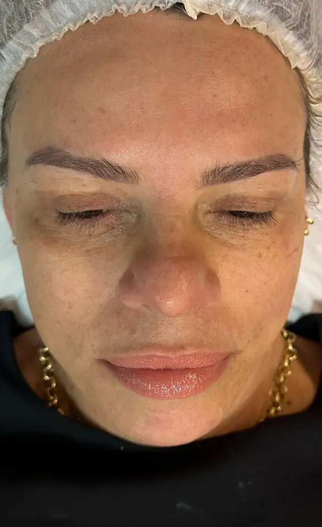 Antes — resultado facial