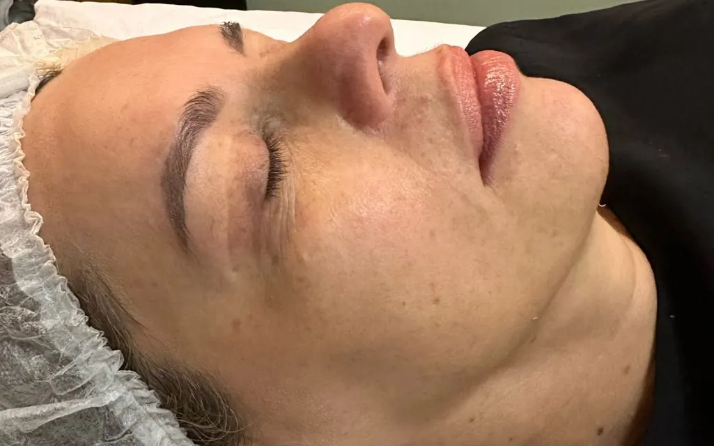 Antes — resultado facial