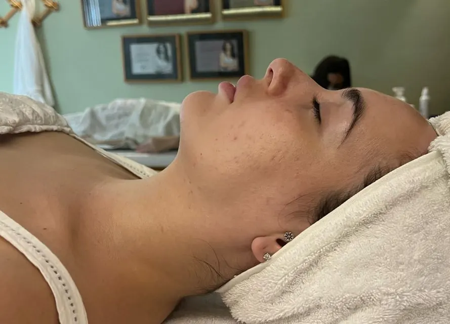 Antes — resultado facial