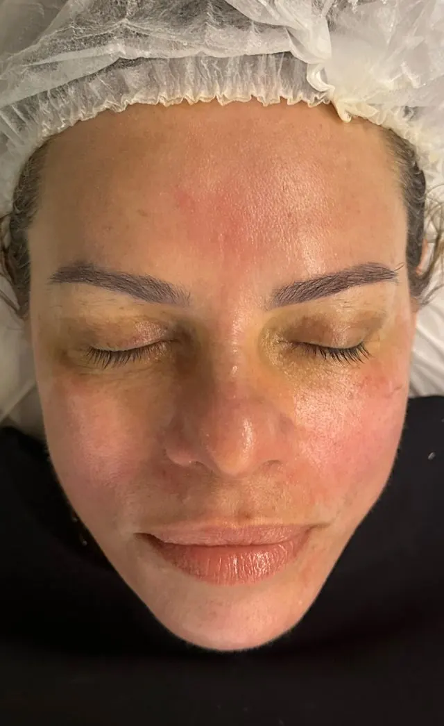 Depois — resultado facial